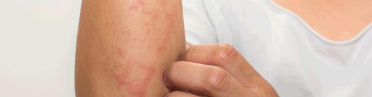 Dermatite atopica: nuove ricerche individuano la responsabilità del microbiota del derma