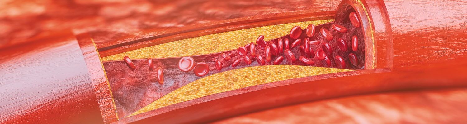 Esiste una correlazione tra tra microbi intestinali e processo di aterosclerosi. La ricerca condotta dall’Università del Wisconsin-Madison