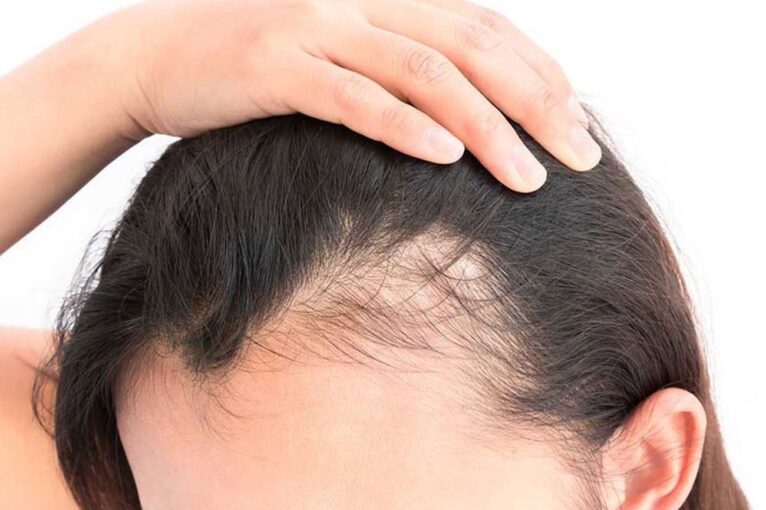 L’alopecia nelle donne: cause, impatto sulla qualità della vita, rimedi